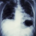 Legal Options for Lung Cancer Patients Exposed to Asbestos: What You Need to Know