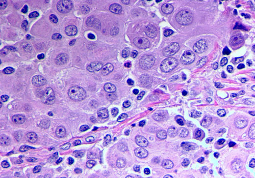 Understanding the Different Types and Stages of Mesothelioma