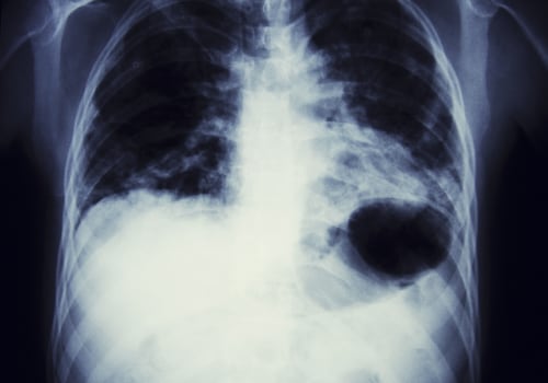 Legal Options for Lung Cancer Patients Exposed to Asbestos: What You Need to Know